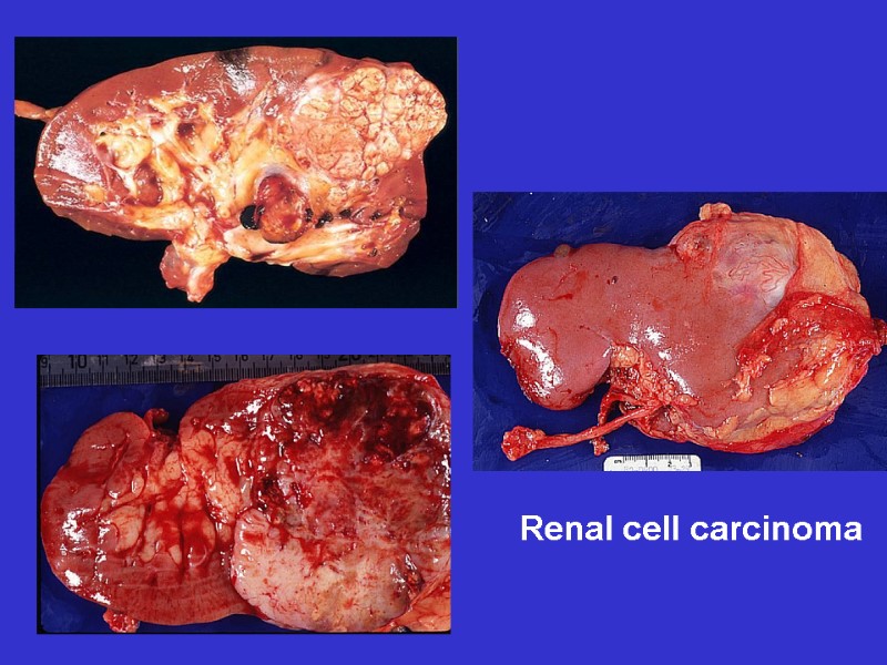 Renal cell carcinoma